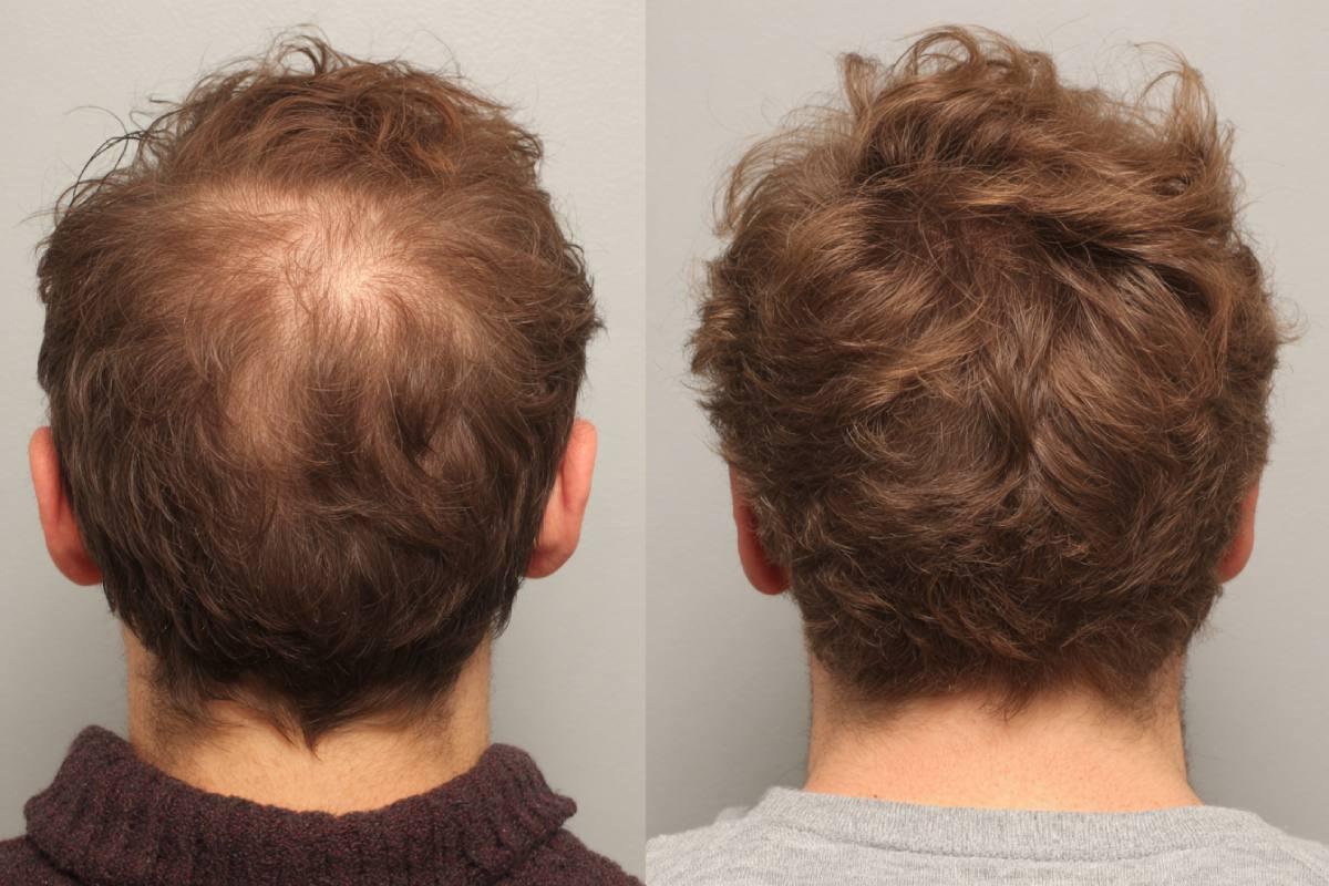 Queda de Cabelo: Causas Mais Comuns e Como Tratar de Forma Eficaz