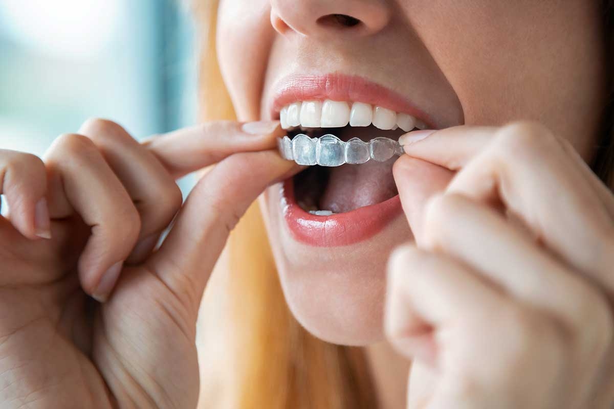 Invisalign em Guanambi / BA